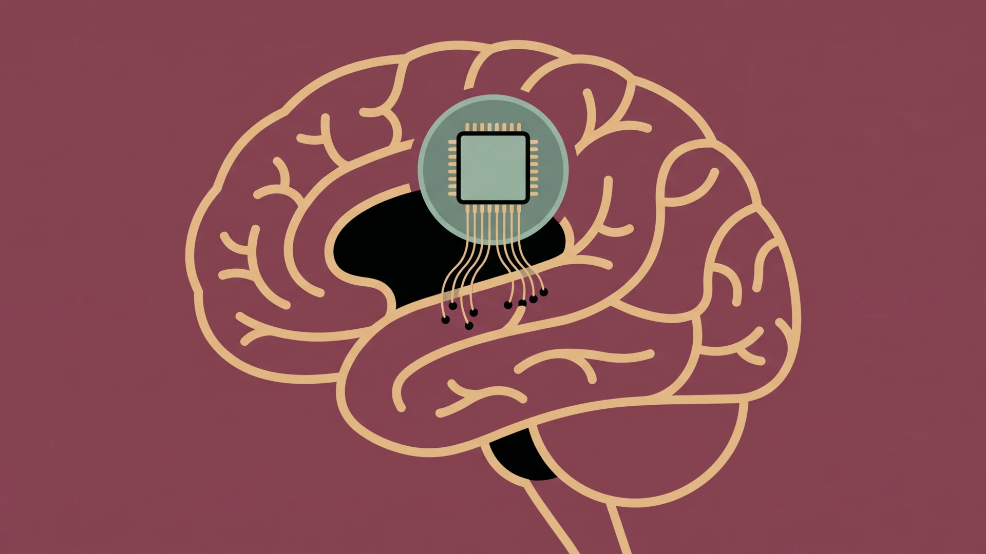 Chiny wszczepiły pierwszy komercyjny implant mózgowy. Neuralink ma konkurenta