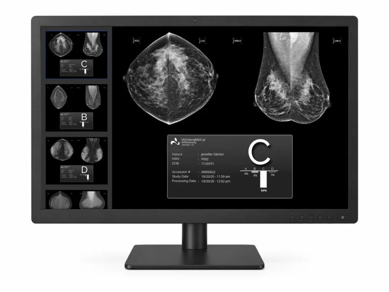AI skraca drogę od mammografii do leczenia raka piersi