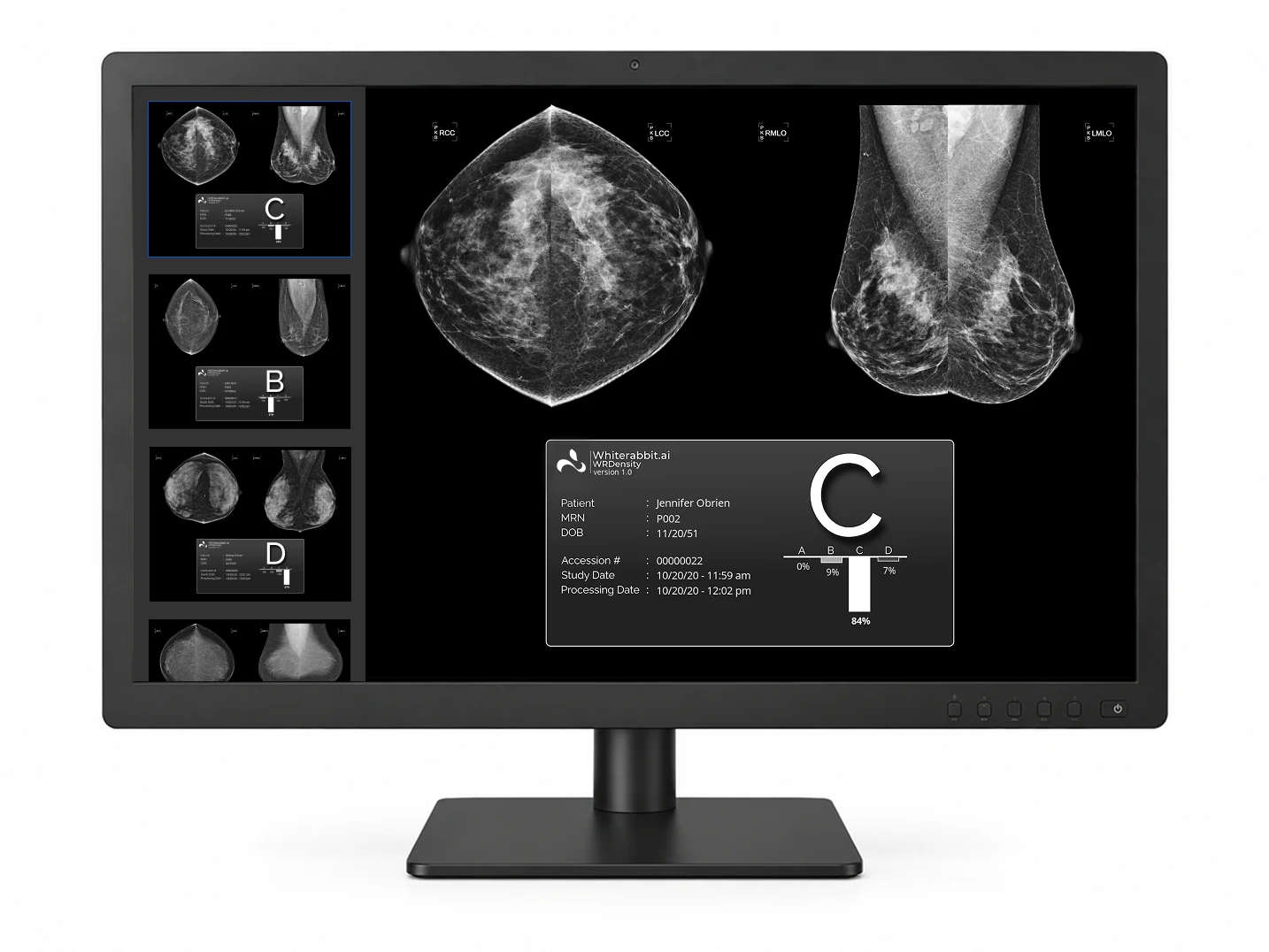 AI skraca drogę od mammografii do leczenia raka piersi