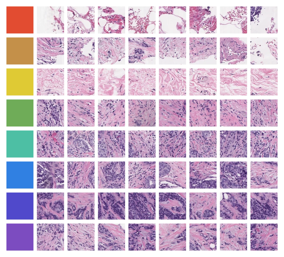 AI skraca drogę od mammografii do leczenia raka piersi